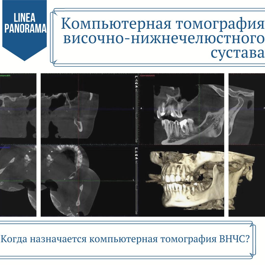 КТ ВНЧС